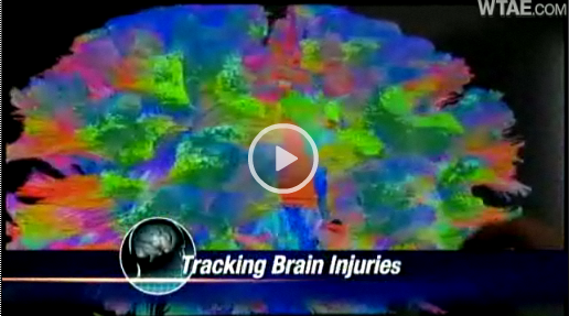 New Technology Offers High-Def Look at Brain - WTAE link